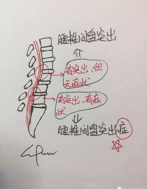 腰椎间盘突出怎么办？