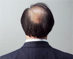 为什么年轻人有越来越多的秃顶？