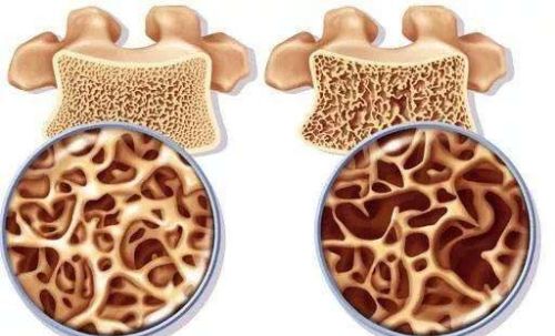 骨质疏松是怎么引起的？