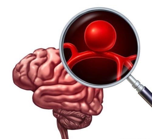 脑溢血发病前有什么征兆吗？