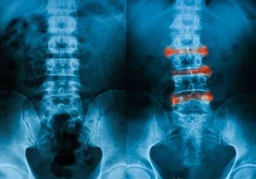 强直性脊柱炎能活多久？