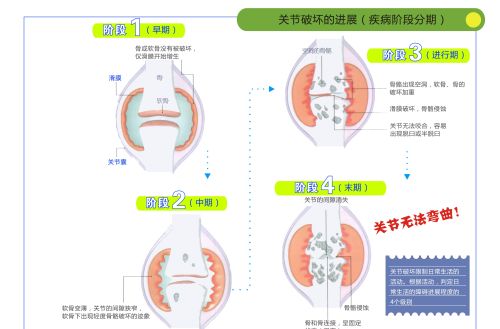 有人说类风湿能根治，真的吗？你怎么看？