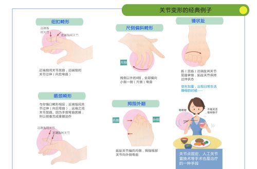 有人说类风湿能根治，真的吗？你怎么看？