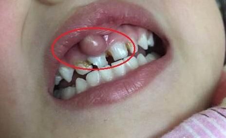 小孩牙龈上长了个包，里面好像有脓，该怎么办？