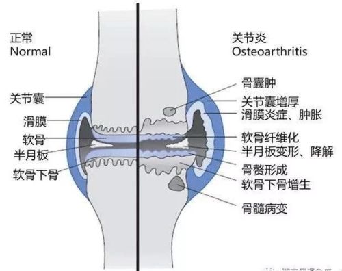 骨关节炎该怎么治疗？