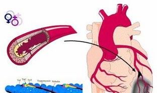 心肌梗塞是一种怎样的感觉？