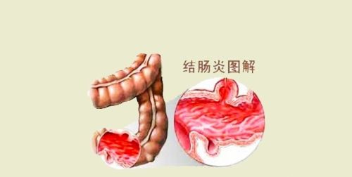 溃疡性结肠炎肚子老是胀气怎么办？