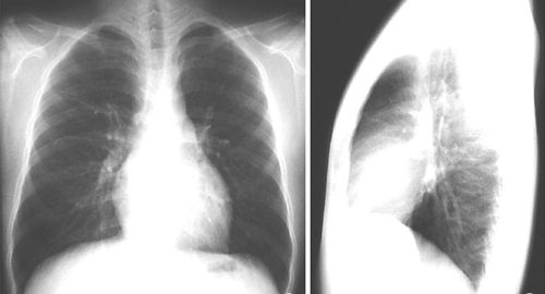 肺癌拍片子能看出来吗？