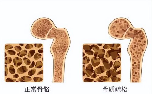 睡觉时老是腿抽筋，就是缺钙？还要留心这4种疾病，别轻视