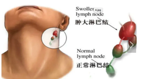 小孩颈部淋巴结肿大：是什么原因？如何治疗？医生带你了解一下