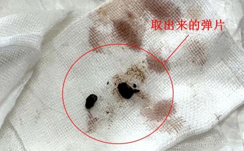 弹片在96岁老兵的身体里藏了72年……致敬！