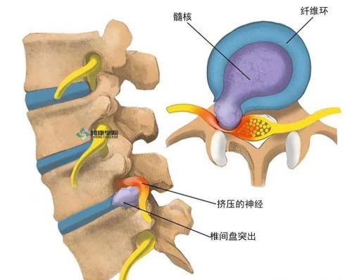 腰椎间盘突出经常爬楼梯有什么影响？