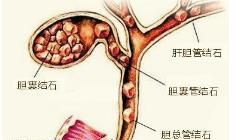 胆结石患者什么情况下需要切除胆囊？