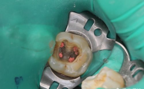 根管治疗后的牙齿一定要戴牙冠吗？