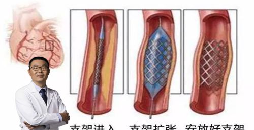 刚确诊为冠心病，一个人在家你害怕过吗？