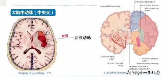 脑血管解剖结构图（概述和血管解剖）(21)