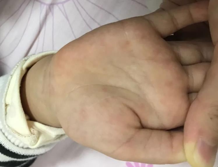 打了手足口疫苗出红疹怎么办