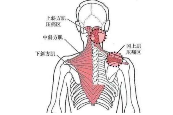 肩胛提肌主要症状有哪些