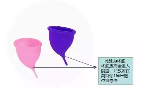 将折叠好的月经杯放入距宫颈1cm处