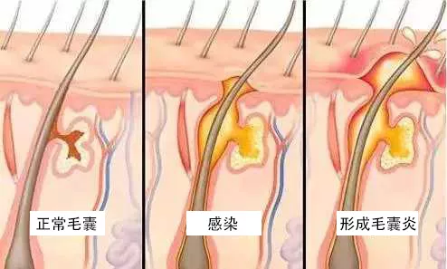 毛囊炎