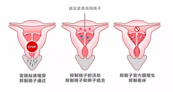 激素类节育环