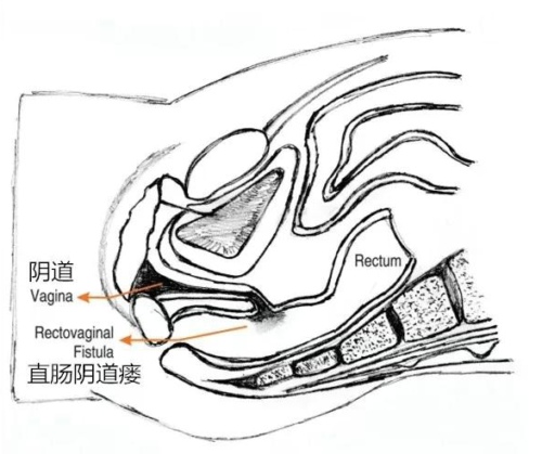 直肠阴道瘘