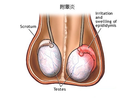 引起附睾睾丸炎的原因