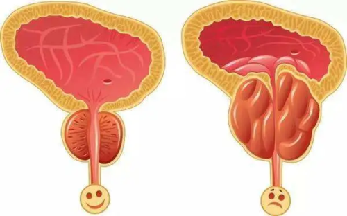 男性前列腺炎能过性生活吗