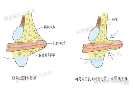 丁丁包裹住而不能显露