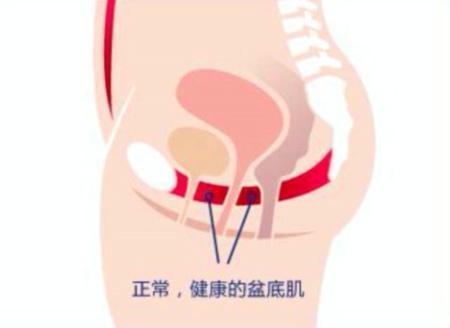 漏尿用缩阴球有效果吗