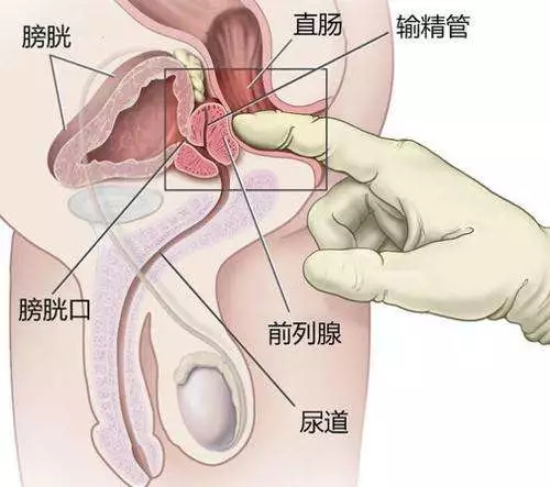 真的有前列腺膏潮吗