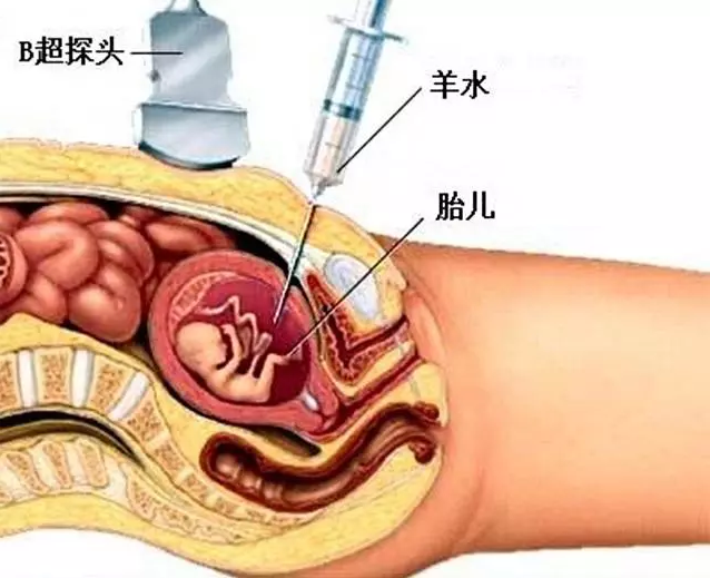 做羊水穿刺多少钱一次