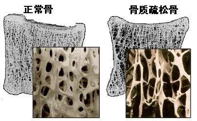 骨质疏松的原因主要是哪些因素