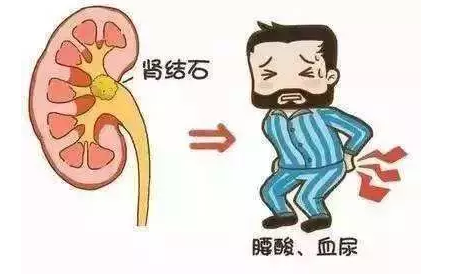 肾结石不能吃什么食物