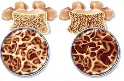骨质疏松怎么治疗效果好吃什么药