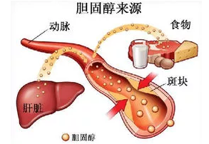 胆固醇高的危害有哪些