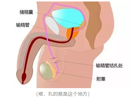 结扎对男性的影响有多大