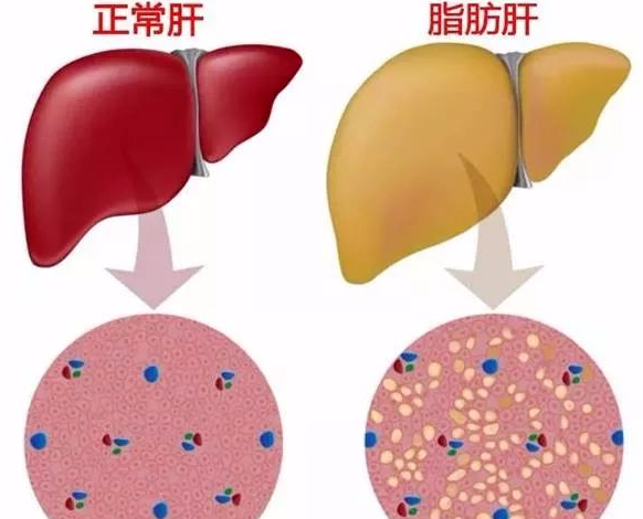 吃什么可以去脂肪肝