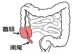 阑尾炎不能吃什么食物