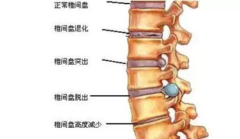 腰椎间盘突出怎么治疗最有效果