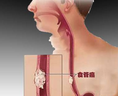食道癌早期症状有哪些反应和表现
