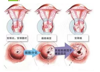 什么是宫颈糜烂它是怎样形成的