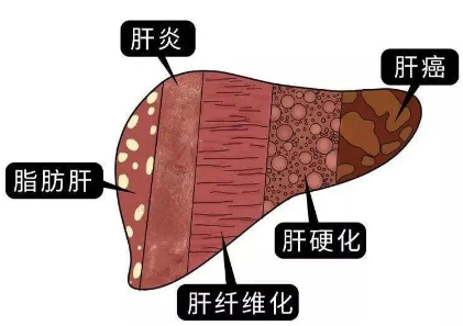 脂肪肝怎么治疗最好的方法 