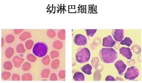 淋巴细胞百分比偏高 