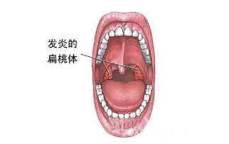 扁桃体发炎怎么办怎样才能消下去