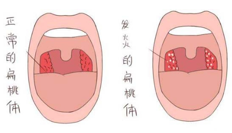 扁桃体发炎吃什么食物