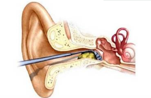 耳朵流水是怎么回事,怎么治疗