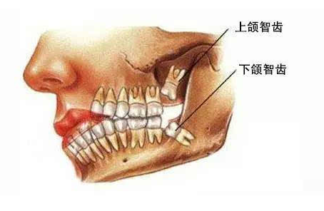 为什么会长智齿，长智齿一定要拔吗