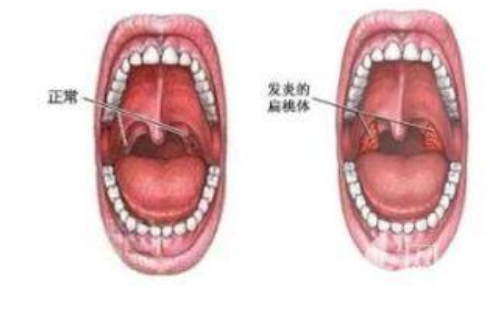 扁桃体炎反复发作怎么办，切除有影响么