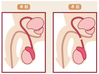 男生结扎了还可以射精吗